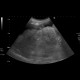 Liver cirrhosis, ascites: US - Ultrasound